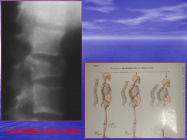 VERTEBRAL FRACTURE 