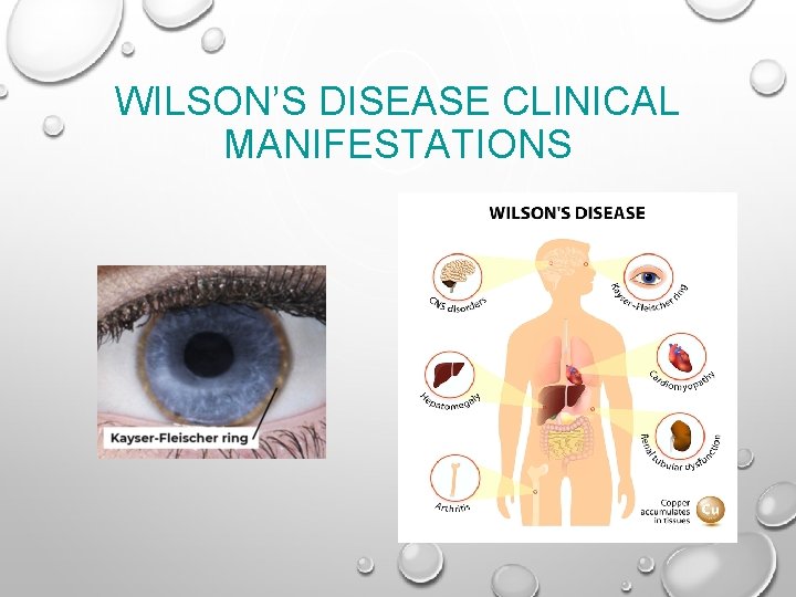 WILSON’S DISEASE CLINICAL MANIFESTATIONS 