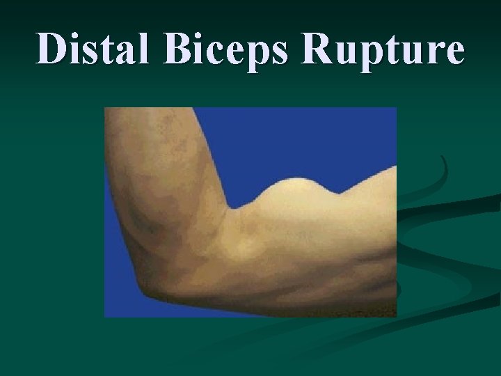Distal Biceps Rupture 