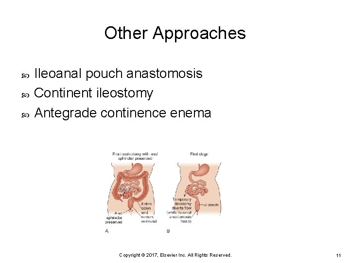 Other Approaches Ileoanal pouch anastomosis Continent ileostomy Antegrade continence enema Copyright © 2017, Elsevier