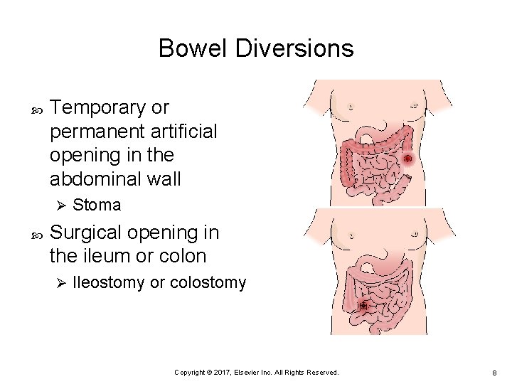 Bowel Diversions Temporary or permanent artificial opening in the abdominal wall Ø Stoma Surgical