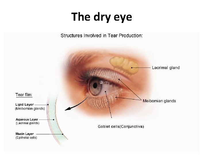 The dry eye 