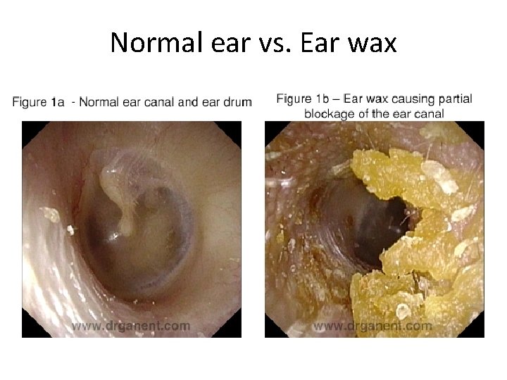 Normal ear vs. Ear wax 