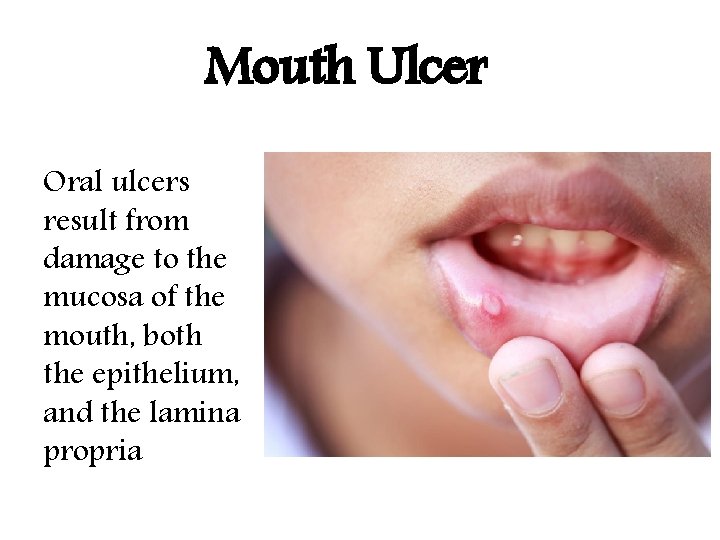 Mouth Ulcer Oral ulcers result from damage to the mucosa of the mouth, both