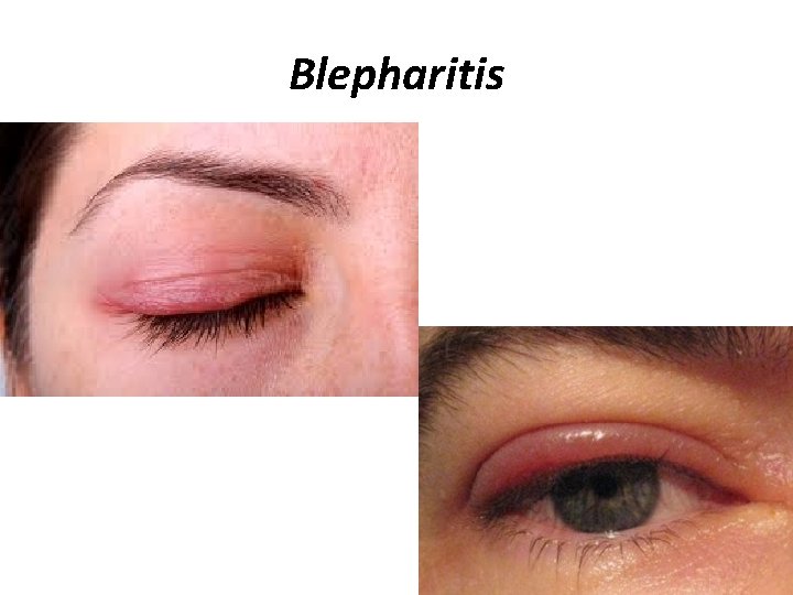 Blepharitis 