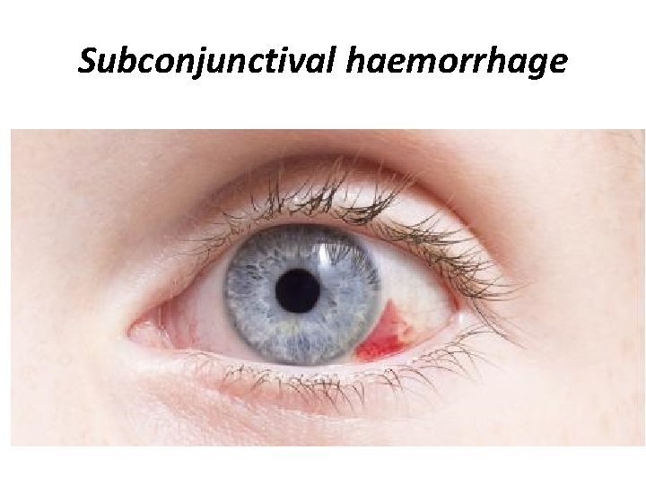 Subconjunctival haemorrhage 