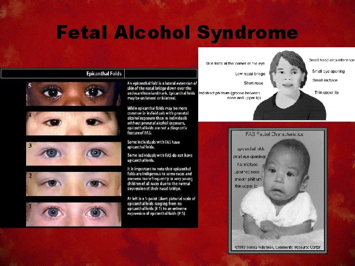 Fetal Alcohol Syndrome 