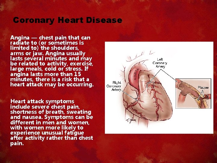 Coronary Heart Disease Angina — chest pain that can radiate to (or sometimes is