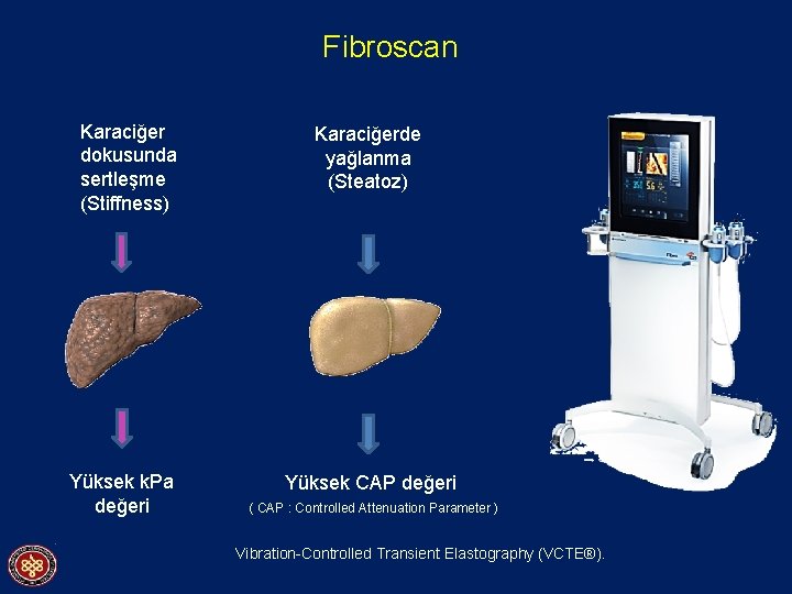 Fibroscan Karaciğer dokusunda sertleşme (Stiffness) Yüksek k. Pa değeri Karaciğerde yağlanma (Steatoz) Yüksek CAP