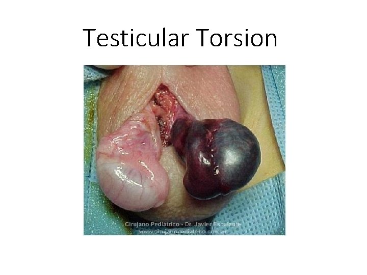 Testicular Torsion 