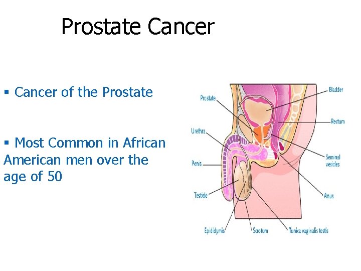 Prostate Cancer § Cancer of the Prostate § Most Common in African American men