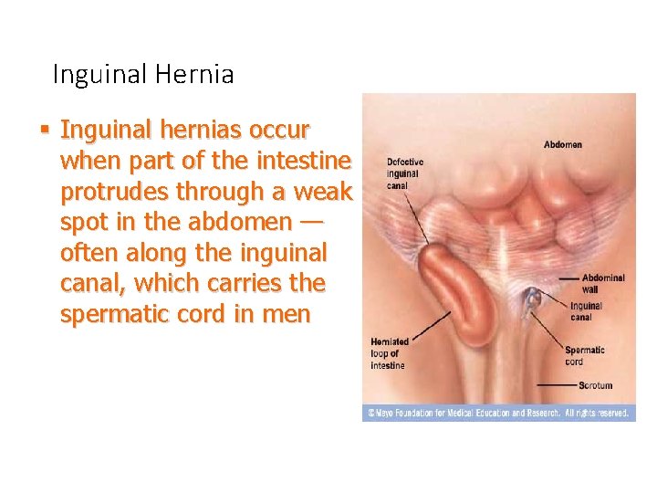 Inguinal Hernia § Inguinal hernias occur when part of the intestine protrudes through a
