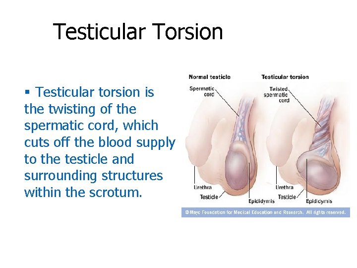 Testicular Torsion § Testicular torsion is the twisting of the spermatic cord, which cuts