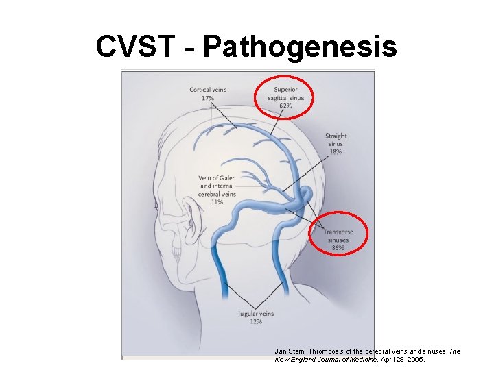 CVST - Pathogenesis Jan Stam. Thrombosis of the cerebral veins and sinuses. The New