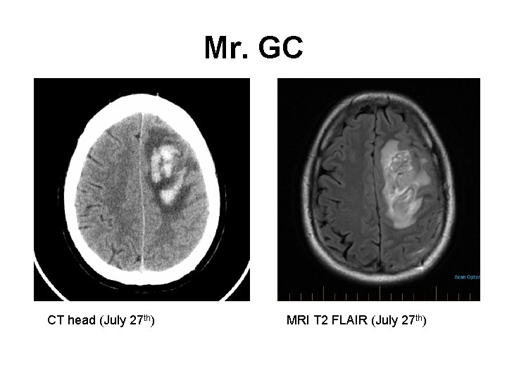 Mr. GC CT head (July 27 th) MRI T 2 FLAIR (July 27 th)