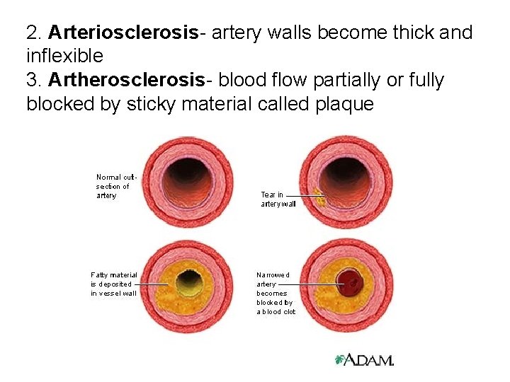 2. Arteriosclerosis- artery walls become thick and inflexible 3. Artherosclerosis- blood flow partially or