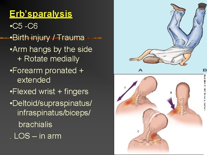 Erb’sparalysis • C 5 -C 6 • Birth injury / Trauma • Arm hangs