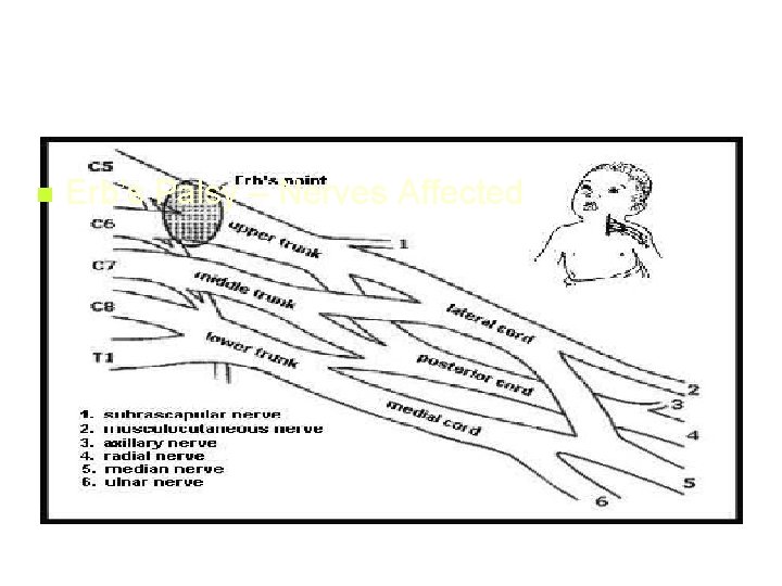 n Erb’s Palsy – Nerves Affected 