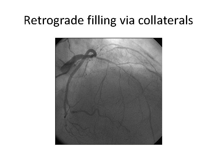 Retrograde filling via collaterals 
