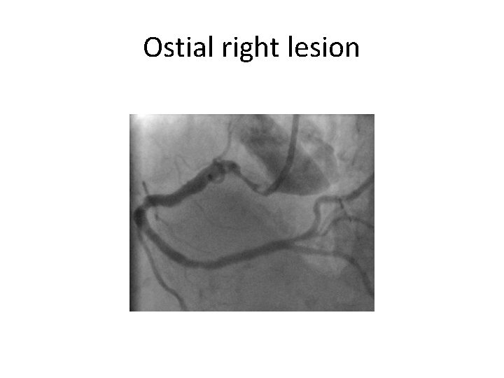 Ostial right lesion 