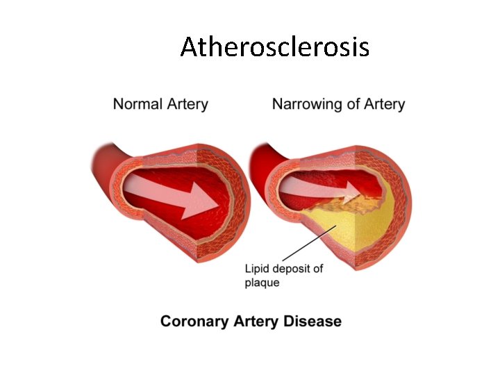 Atherosclerosis 