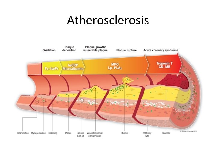 Atherosclerosis 