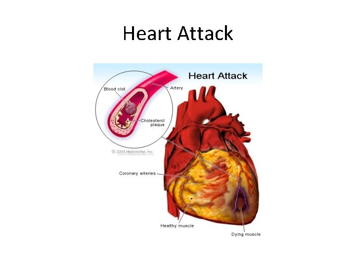 Heart Attack 