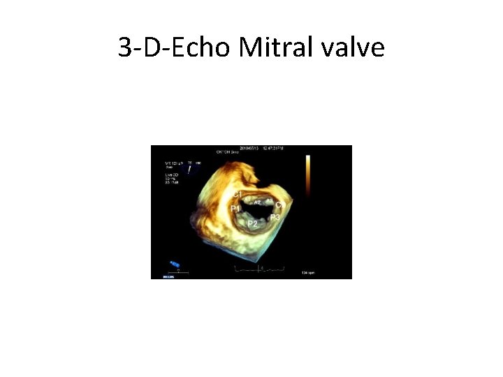 3 -D-Echo Mitral valve 