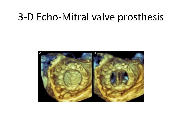 3 -D Echo-Mitral valve prosthesis 