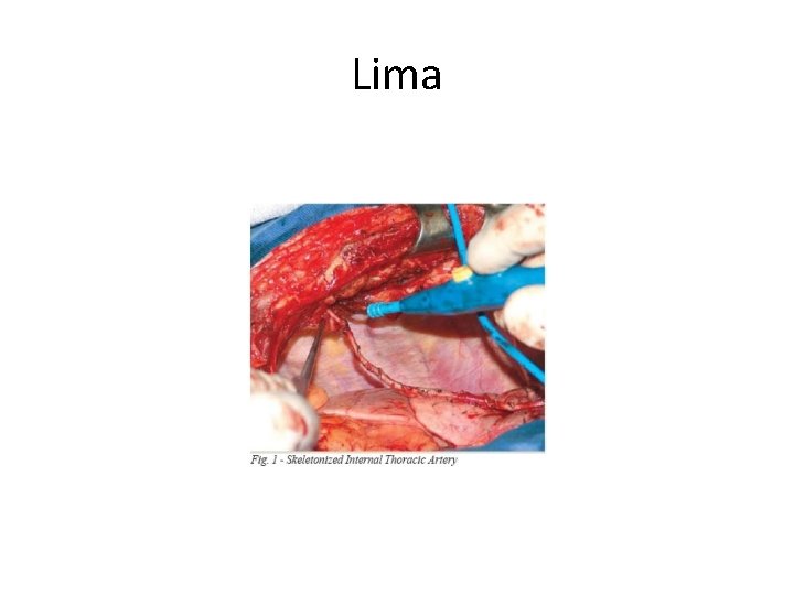 Lima 