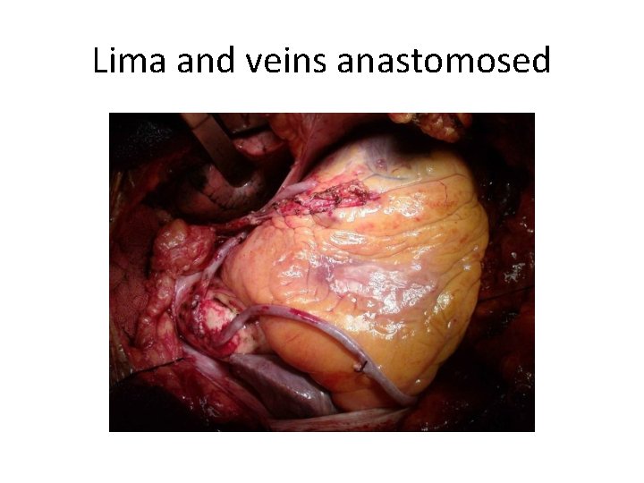 Lima and veins anastomosed 