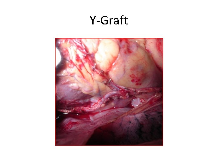 Y-Graft 