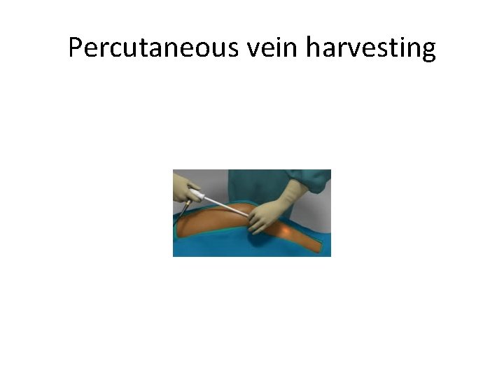 Percutaneous vein harvesting 