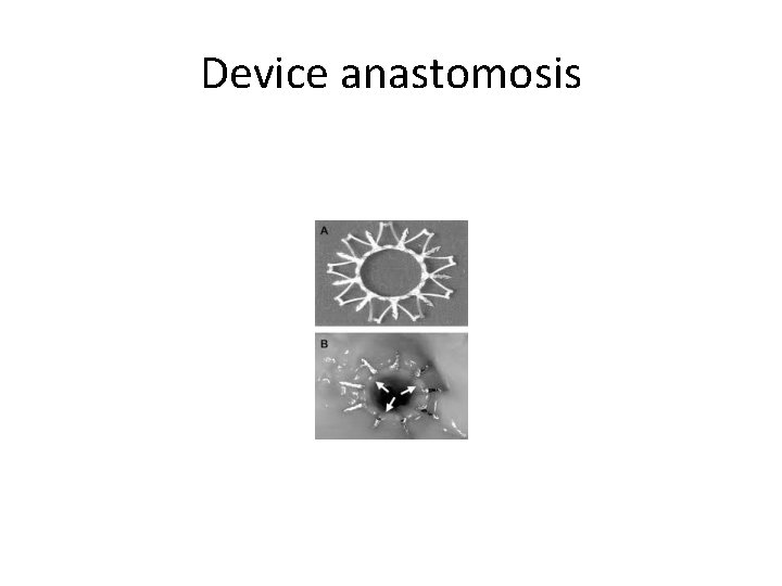 Device anastomosis 