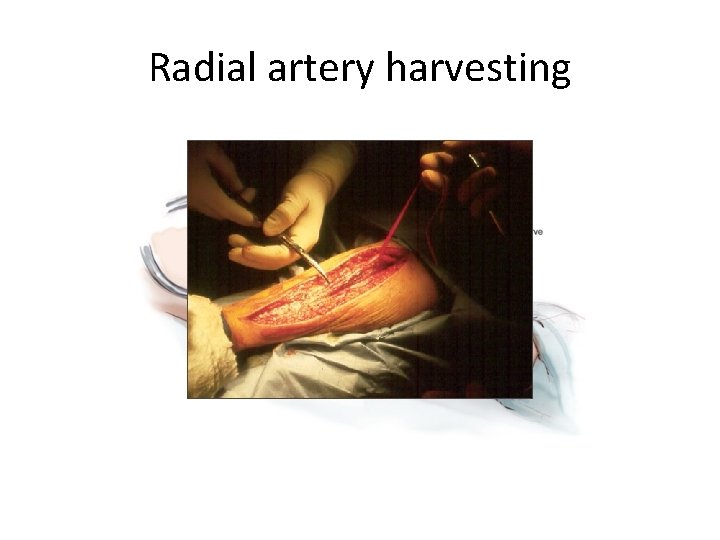 Radial artery harvesting 