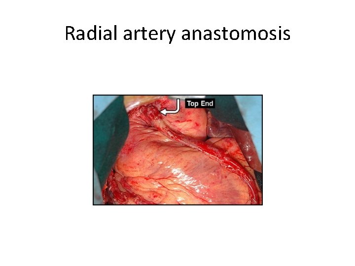 Radial artery anastomosis 
