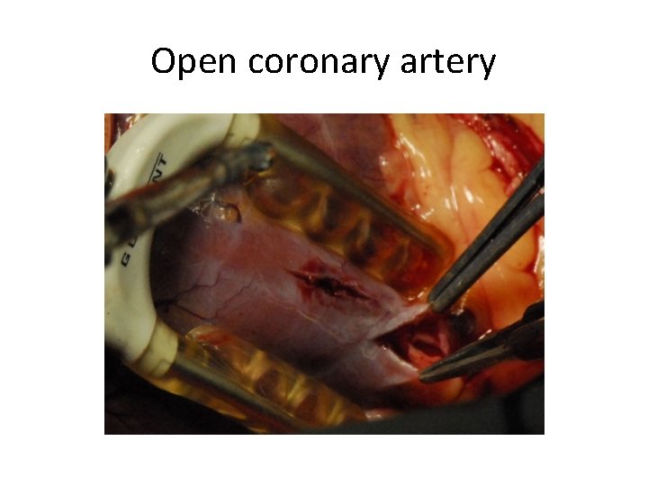 Open coronary artery 