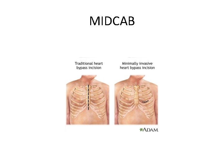 MIDCAB 