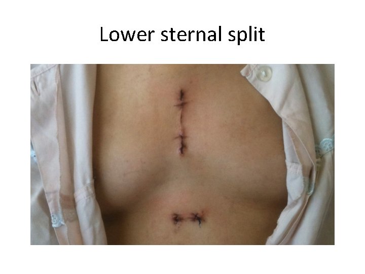 Lower sternal split 