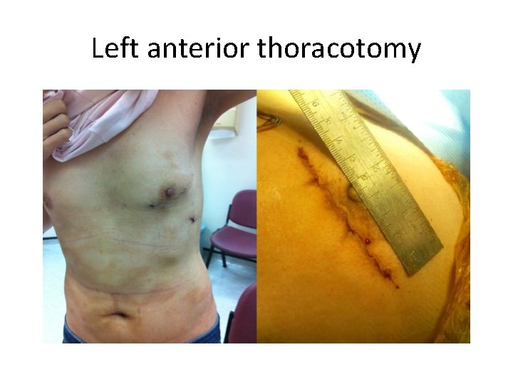 Left anterior thoracotomy 