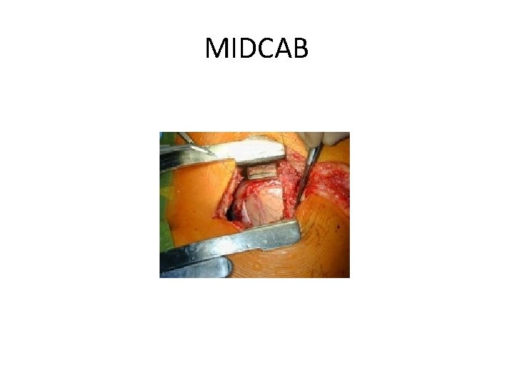 MIDCAB 
