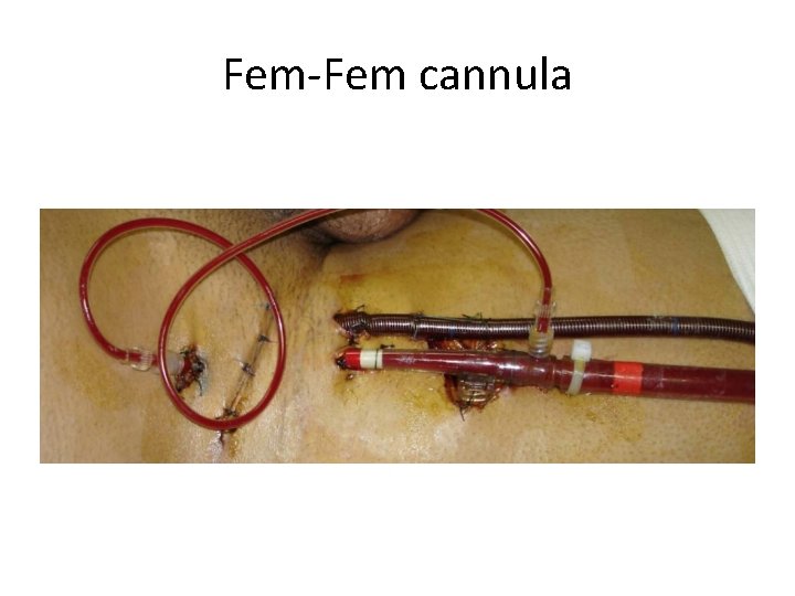Fem-Fem cannula 