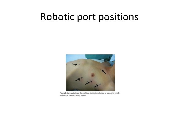 Robotic port positions 