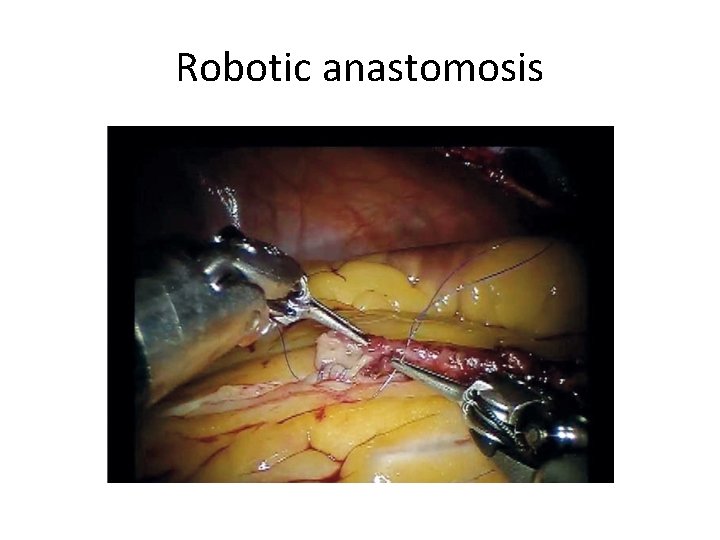 Robotic anastomosis 