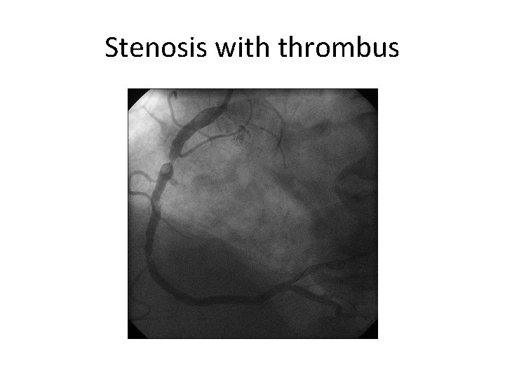 Stenosis with thrombus 