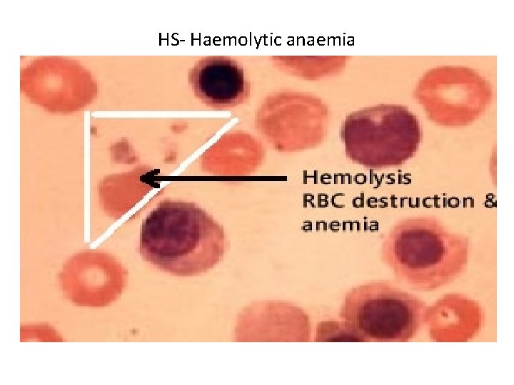 HS- Haemolytic anaemia 