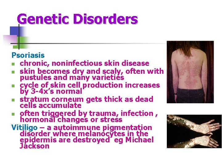 Genetic Disorders Psoriasis n chronic, noninfectious skin disease n skin becomes dry and scaly,