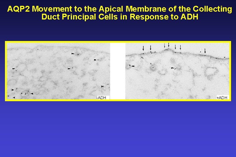 AQP 2 Movement to the Apical Membrane of the Collecting Duct Principal Cells in