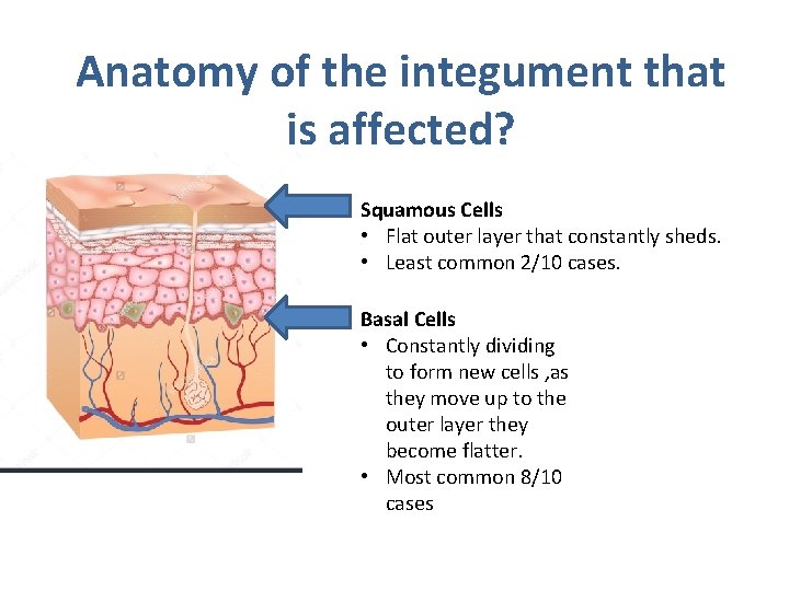 Anatomy of the integument that is affected? Squamous Cells • Flat outer layer that