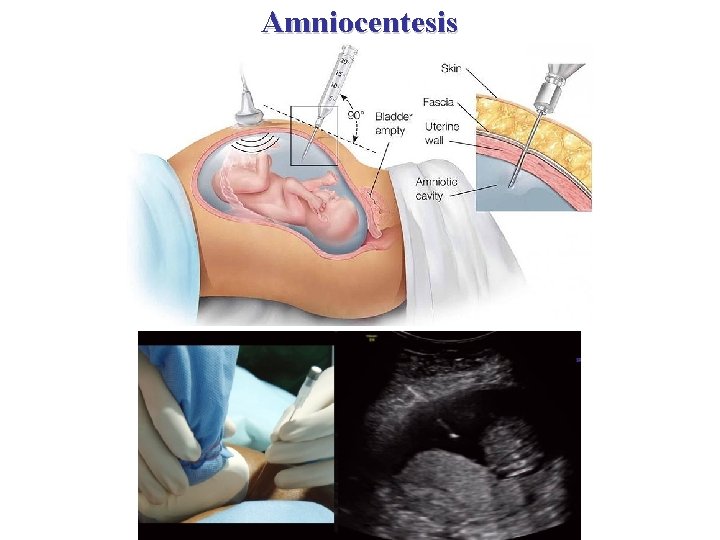 Amniocentesis 